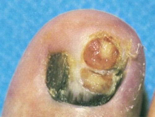 Ulceration