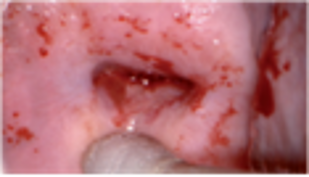Atrophic Cervix