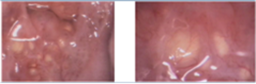 Nabothian follicles