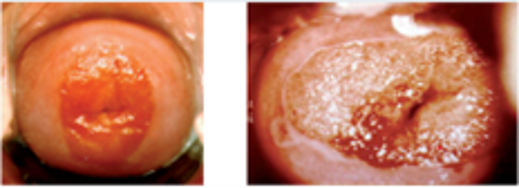 Cervical Ectropion