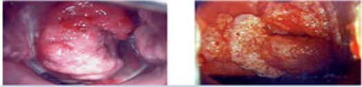 Cervical cancer