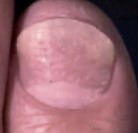 Psoriasis