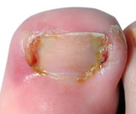 ingrowing nail